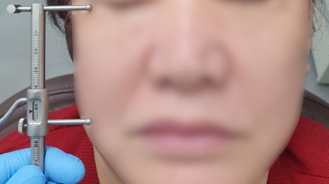 Prosthetics After Implants in Ogeum-dong: Occlusion and Facial Balance Matter Too image 6
