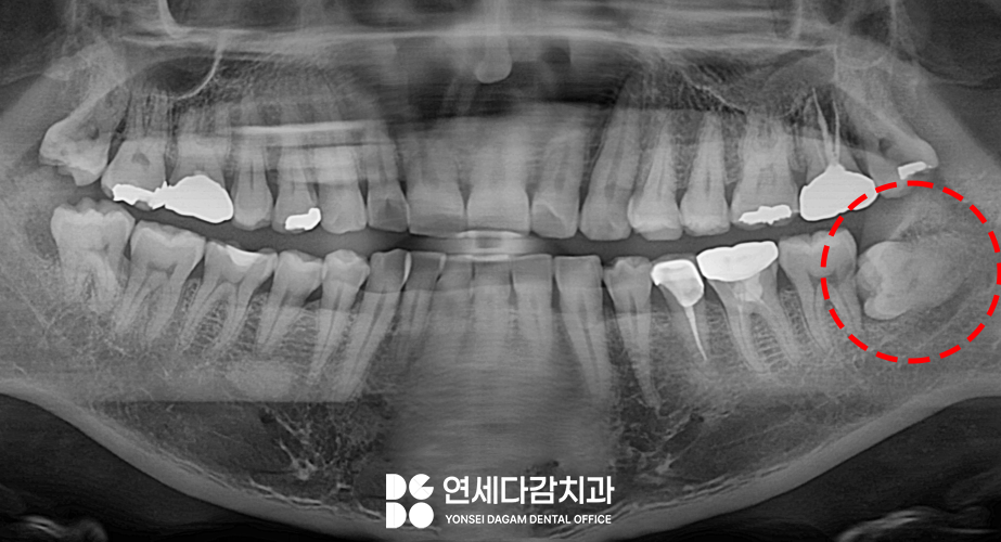 신경과 가까운 매복 사랑니 절반만 잘라서 남긴다고요? 오금역 치과 에서 알려드리는 치관절제술 통한 안전한 발치! 관련 이미지 5