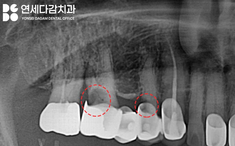 크라운 또는 브릿지 같은 보철 치료 했던 부위에 충치 또는 잇몸질환 생기는 이유 가락시장역 치과 치근우식 생겼을 때 발치 후 임플란트 관련 이미지 1