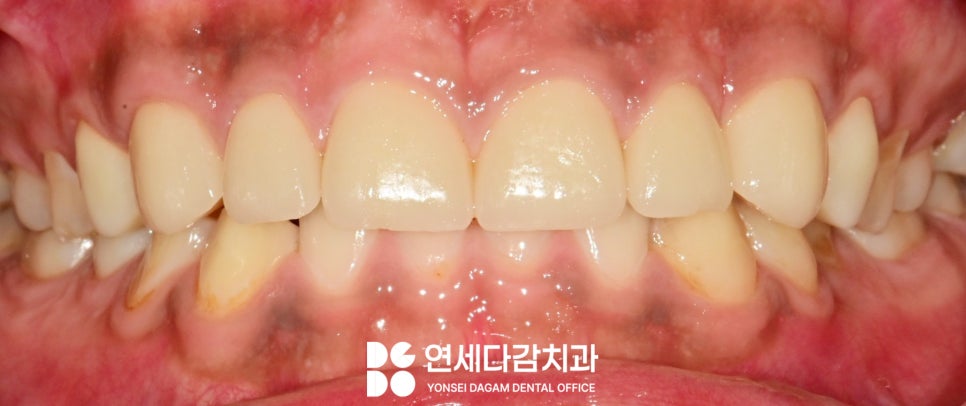마모로 인한 치아 교모증 문정동 치과 에서 원인과 크라운 치료 방법 알려드리겠습니다. 관련 이미지 8