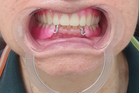 Seokchon-dong Dental Clinic, 연세다감치과: Why You Should Carefully Review the Denture-Making Steps · Process from the Beginning image 2