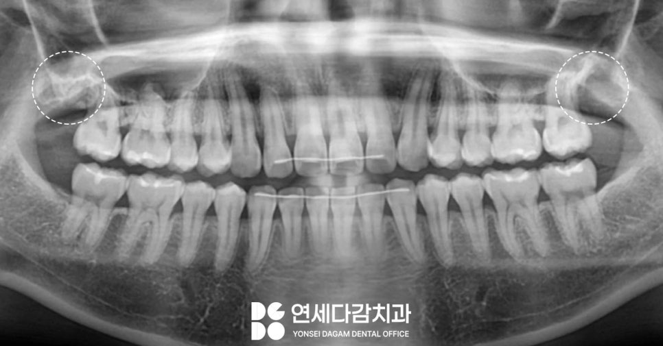 기울어진 매복 사랑니 발치 더 주의깊게 봐야 되는 이유 개롱역 치과 에서 살펴봅시다. 관련 이미지 6