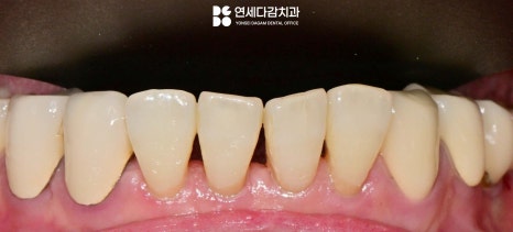 앞니 레진 후 생긴 변색 문제와 삐뚤어진 치아 개롱역 치과 최소삭제 라미네이트 적용할 수 있는 이유 관련 이미지 6