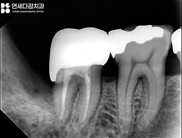 사랑니 주변 음식물 끼임 방치하면 멀쩡한 치아를 잃을 수 있습니다 개롱역 치과 에서 알아보는 보존 가능성 관련 이미지 2