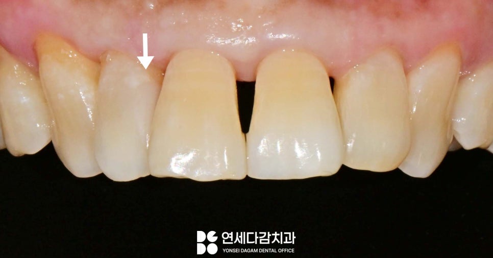 앞니 충치 꼭 크라운 해야 좋을까 송파역 치과 치아 사이 인접면 우식 레진 치료 만으로 충분한 경우 관련 이미지 6