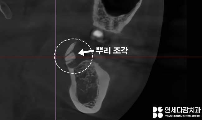 거여동 치과 매복 사랑니 발치 후 치아 뿌리 조각 부러짐 잔존치근 일부러 남겨두는 이유 관련 이미지 6
