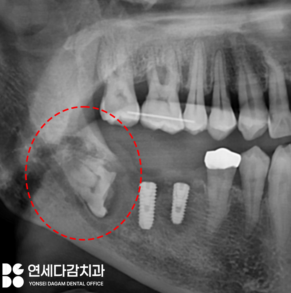 신경과 가까운 매복 사랑니 절반만 잘라서 남긴다고요? 오금역 치과 에서 알려드리는 치관절제술 통한 안전한 발치! 관련 이미지 3