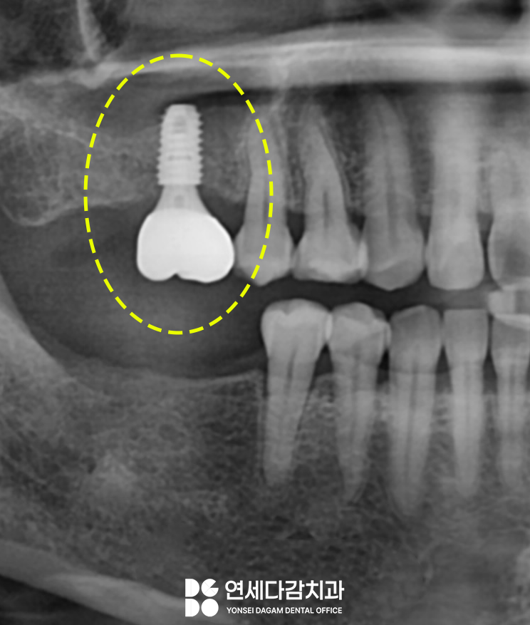 발치 후 생기는 잇몸뼈의 변화로 임플란트 과정이 복잡해질 수 있습니다 경찰병원역 치과 에서 알아보는 상악동 거상술. 관련 이미지 4