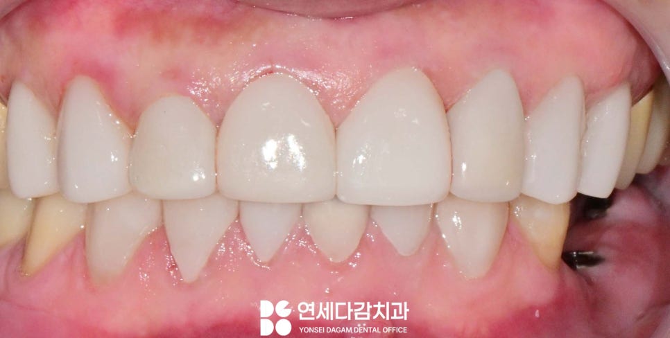 하얀 치아가 가져오는 인상의 변화 오금동 치과 교정 없이 최소삭제 라미네이트 심미치료 통해 치열 및 누렁니 개선 관련 이미지 7