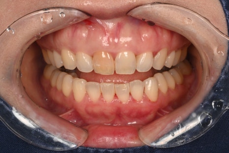 Geoyeo-dong Dental Clinic: Case of Internal Bleaching for a Discolored Front Tooth After Trauma image 2
