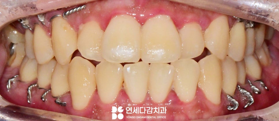 문정역 치과 에서 알아보는 턱뼈 골절 됐을 때 악간고정술 치료 같이 진행하는 이유 관련 이미지 4