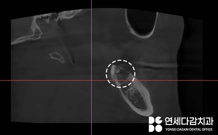 If the gums keep swelling and pus keeps coming out after impacted wisdom tooth extraction, how to find tooth root fragments remaining in the jawbone at a dental clinic in Songpa District image 6