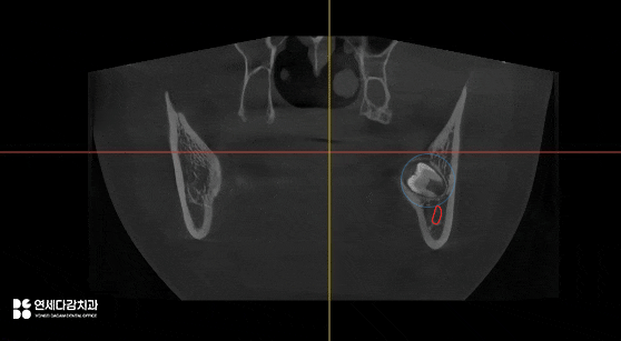 가락동 치과 교정 치료 전 사랑니 발치 꼭 필요할까? - 미성숙 매복케이스로 알아보는 과정 관련 이미지 5