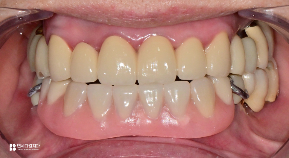 오금역 치과 부분틀니, 예후를 고려한 지대치 평가부터 정밀한 설계까지 중요한 이유 관련 이미지 9