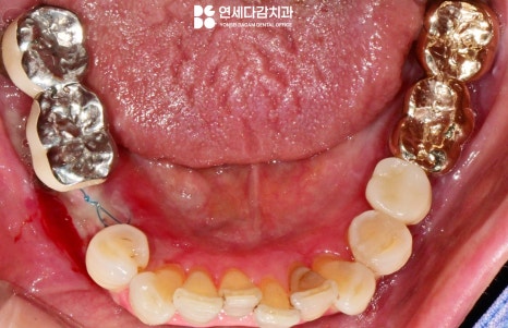 잇몸이 붓고 피나고 냄새날 때 송파역 치과 구강암 증상과 비슷한 급성 궤양성 치은염 (ANUG) 잇몸치료 통한 치주질환 개선 관련 이미지 5