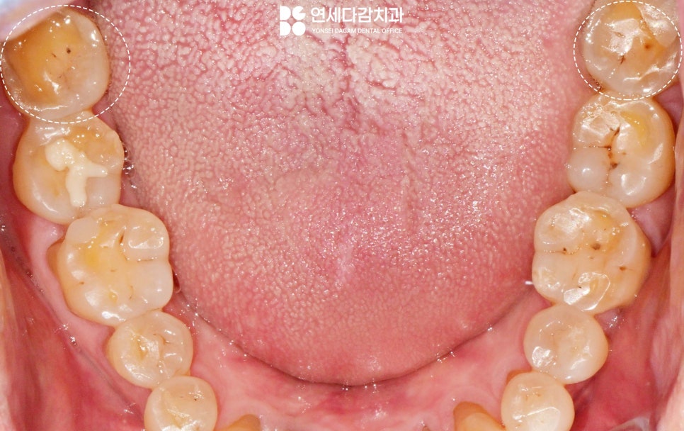 심한 이갈이 원인으로 생기는 치아 마모 및 파절 문제 문정역 치과 교모증 크라운 치료 필요한 이유 관련 이미지 1