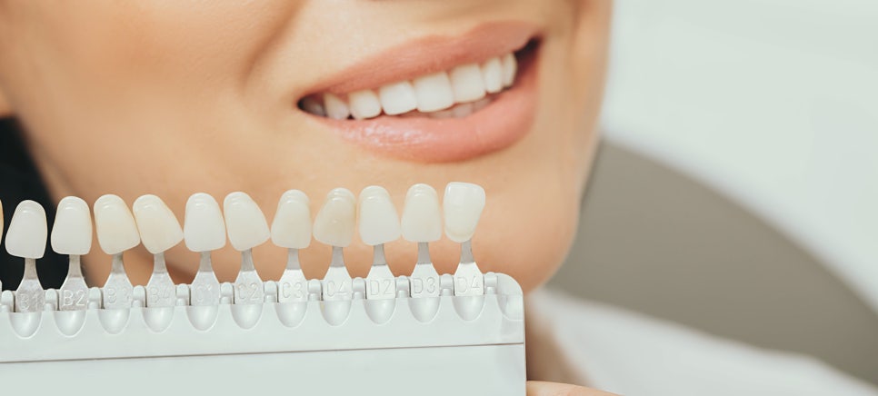 Ogeum-dong Dentist: Want to Improve Front-Tooth Discoloration and Black Triangles at Once with Veneers? <Must-Read> image 4