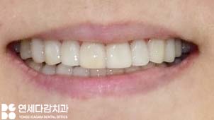 누런이 미백 안 해도 하얀이 원할 때 송파동 치과 최소삭제 라미네이트 과정에서 잇몸 치은 성형술 필요한 이유 관련 이미지 7