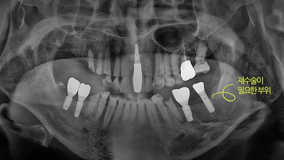 Munjung-dong Dentist: What Does Tooth Attrition Mean, What Are Its Symptoms, and How Is It Treated? image 7