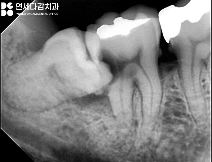 사랑니 주변 음식물 끼임 방치하면 멀쩡한 치아를 잃을 수 있습니다 개롱역 치과 에서 알아보는 보존 가능성 관련 이미지 1
