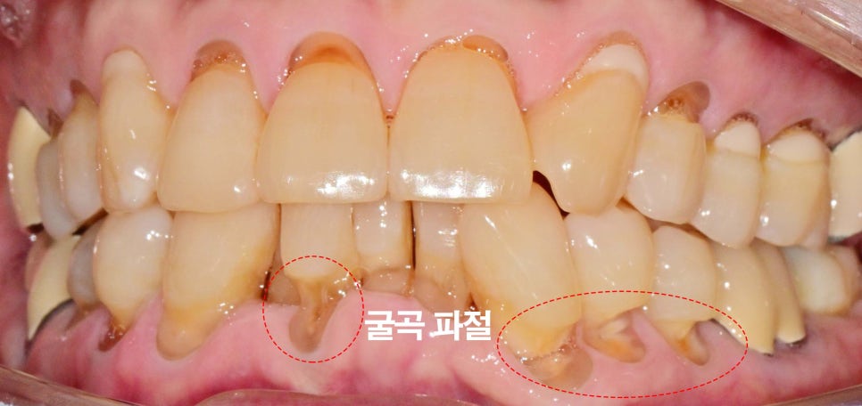 치아 이시림 왜 더 심해질까 개롱역 치과 치경부 마모증 원인과 레진 충전 및 글래스아이오노머(GI) 치료 특징 비교 관련 이미지 3