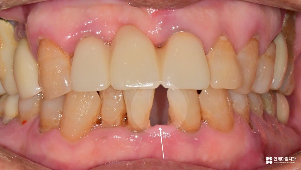 치주염으로 인한 앞니 탈구, 개롱역 치과 에서 설명하는 잠간 고정술 이야기 관련 이미지 1