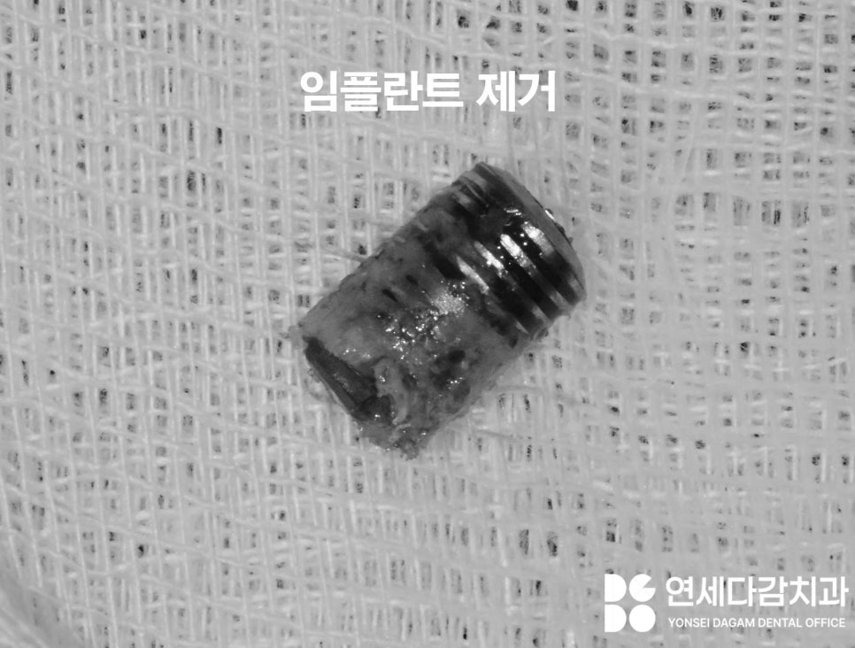 어금니 찌릿한 통증 치아에 금갔을때 신경치료 크라운 가락시장역 치과 충치 깊을 때 당일 발치 임플란트 및 부러진 보철 임플란트재식립 관련 이미지 8