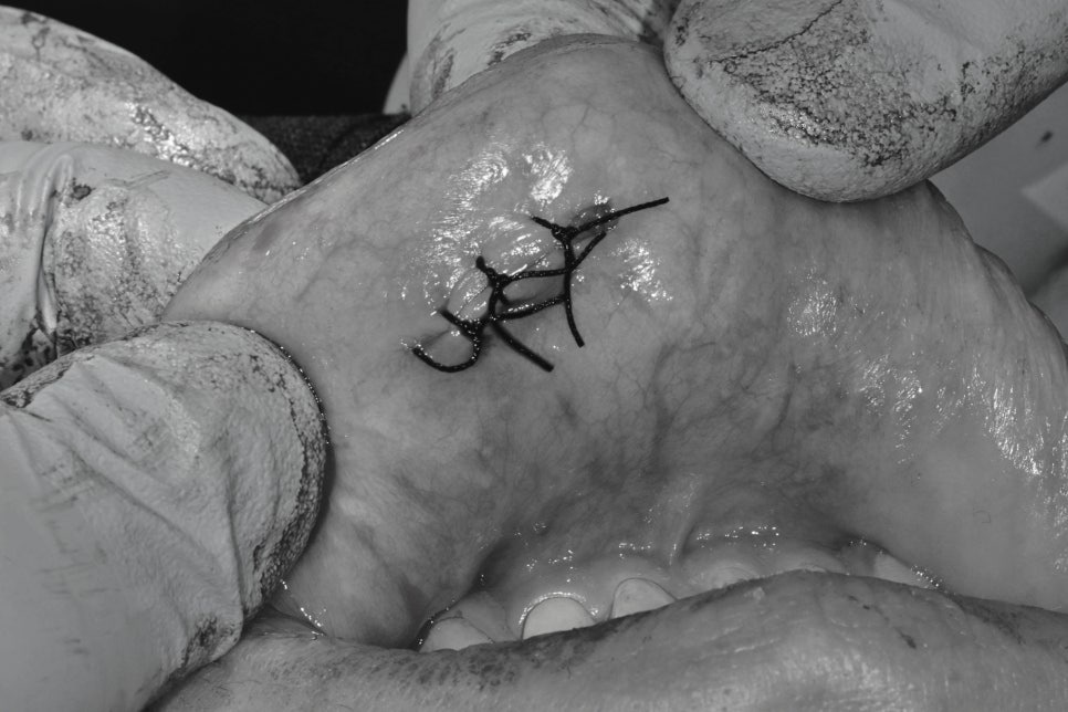 Geoyeo Station Dental Clinic, Mucous Cyst Removal&middot;What If a Lump-Like Bump Protrudes Inside Your Mouth? image 7