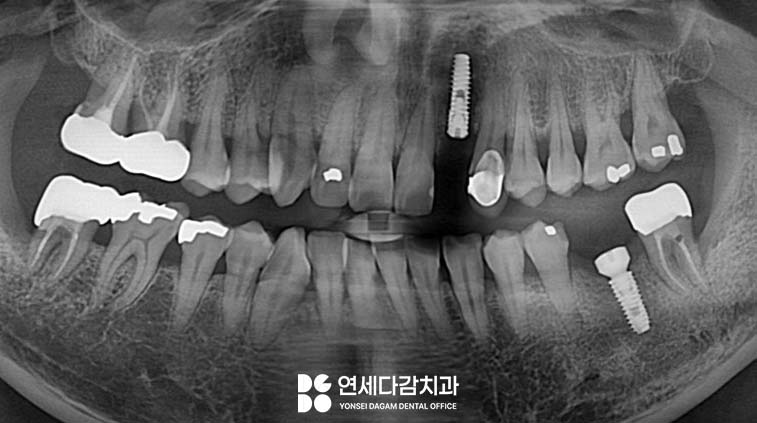 사랑니 주변 음식물 끼임 방치하면 멀쩡한 치아를 잃을 수 있습니다 개롱역 치과 에서 알아보는 보존 가능성 관련 이미지 3