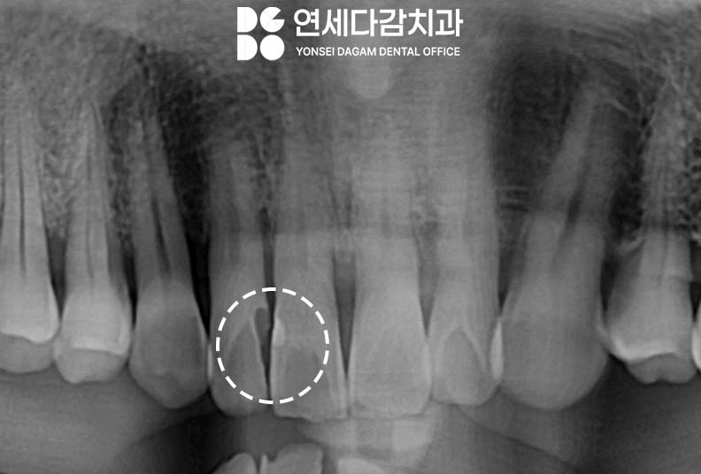 앞니 충치 꼭 크라운 해야 좋을까 송파역 치과 치아 사이 인접면 우식 레진 치료 만으로 충분한 경우 관련 이미지 1