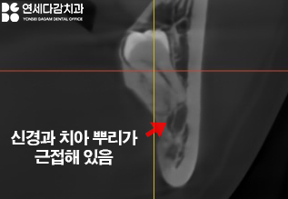 사랑니 부위 잇몸이 붓고 음식물이 자주 껴요 가락동 치과 매복사랑니 발치 후 지혈제 꼭 써야 좋을까? 관련 이미지 5