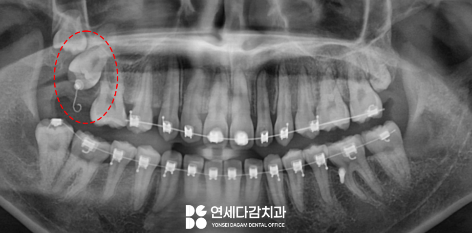 교정 중 사랑니 발치 진단 오금동 치과 에서 설측 수평 매복 발치 과정 알려드리겠습니다. 관련 이미지 6