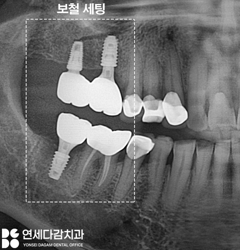 어금니 찌릿한 통증 치아에 금갔을때 신경치료 크라운 가락시장역 치과 충치 깊을 때 당일 발치 임플란트 및 부러진 보철 임플란트재식립 관련 이미지 12