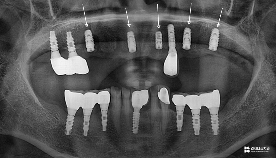 문정동 치과 수면마취(의식하진정법)으로 진행되는 임플란트 수술 관련 이미지 6