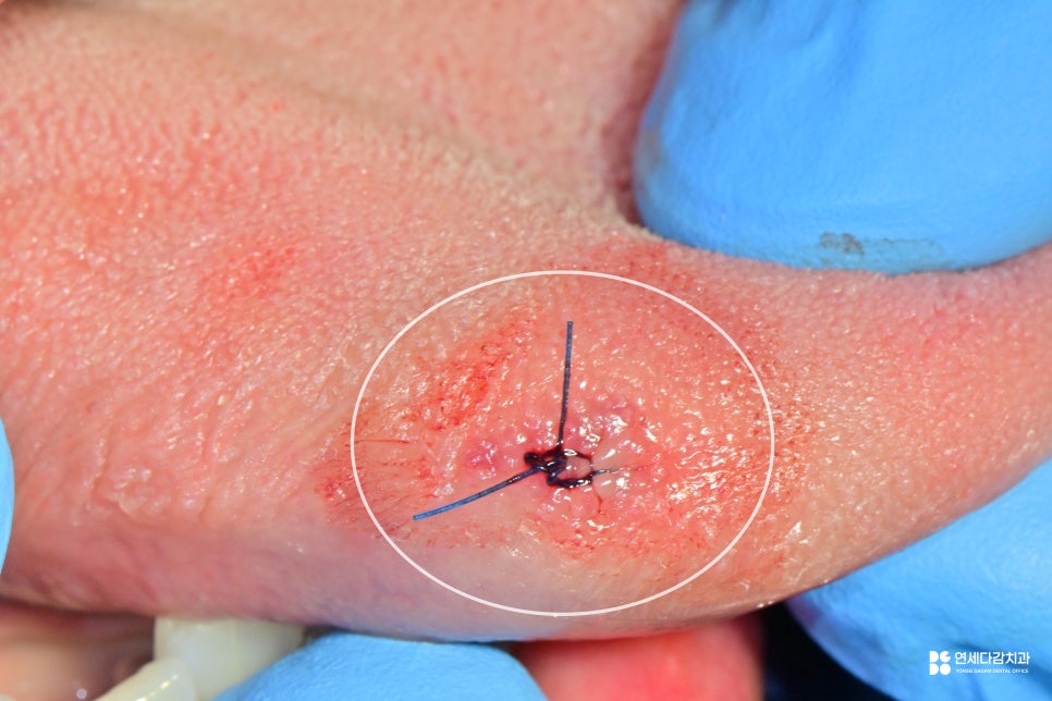 개롱역 치과 혀에 하얀 돌기? 구강 유두종 작아도 조직검사가 필요한 이유 관련 이미지 5