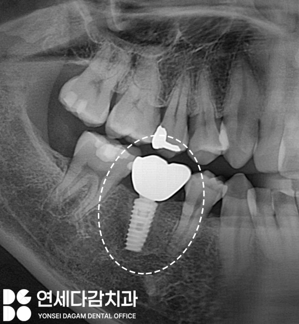 임플란트 빠짐 또는 흔들림 거여역 치과 나사 부러지고 빠졌을 때 재수술 없이 보철 크라운 교체할 수 있는 방법 관련 이미지 9