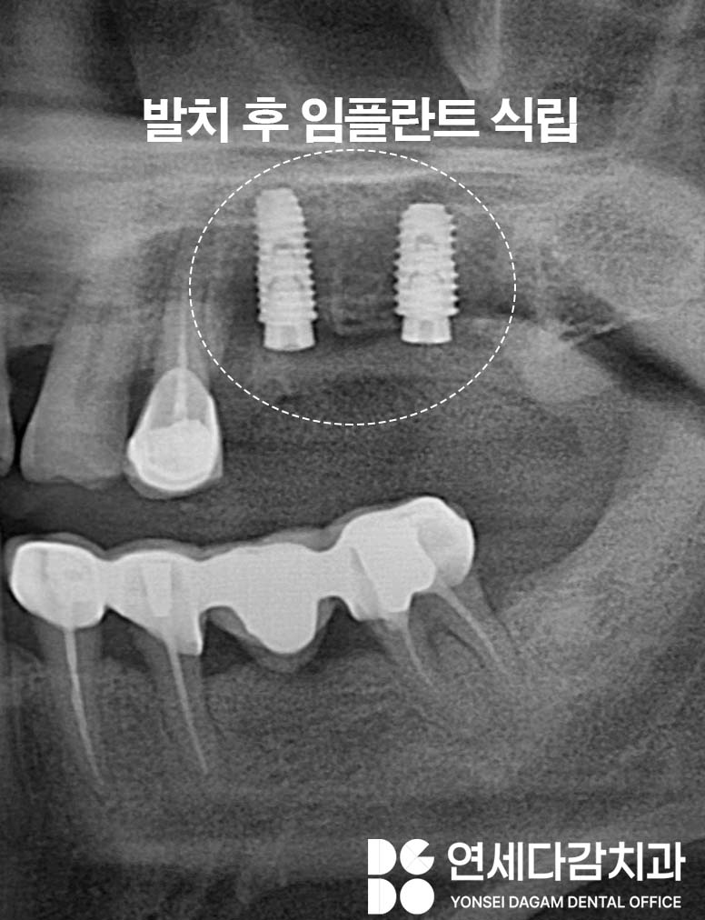 문정역 치과 임플란트 오래 사용하기 위해서 지대주 (어버트먼트) 보철 종류 기성 및 커스텀 지대주 (abutment) 차이 알고 받아야 되는 이유 관련 이미지 4
