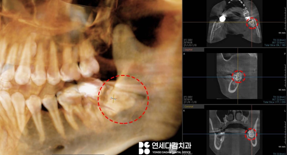 턱관절 통증 송파동 치과 에서 원인 찾고 해결 과정 살펴봅시다.(feat. 초음파 물리치료 및 보톡스 ) 관련 이미지 4