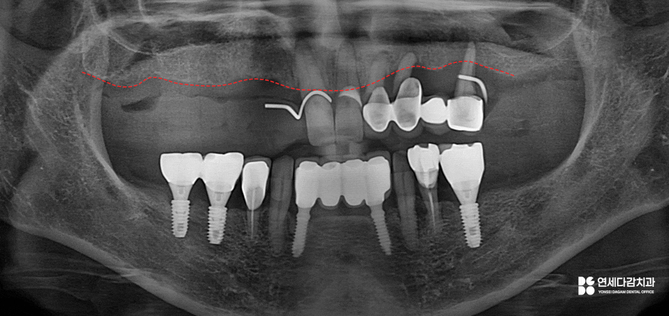 개롱역 치과 치주 질환으로 인한 심한 잇몸뼈 손실 - 네비게이션 방식 임플란트로 진행된 안전한 치료 관련 이미지 1