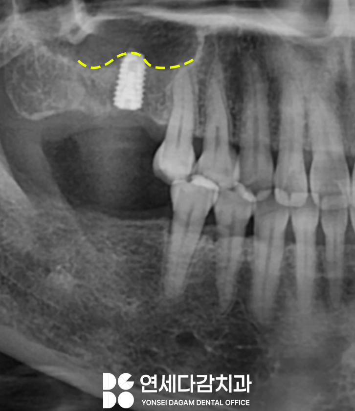 발치 후 생기는 잇몸뼈의 변화로 임플란트 과정이 복잡해질 수 있습니다 경찰병원역 치과 에서 알아보는 상악동 거상술. 관련 이미지 2