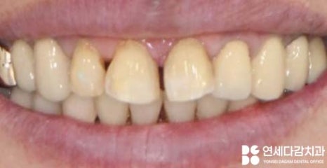 앞니 레진 후 생긴 변색 문제와 삐뚤어진 치아 개롱역 치과 최소삭제 라미네이트 적용할 수 있는 이유 관련 이미지 11