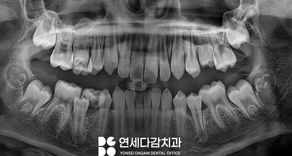 우리 아이 치아 성장 과정 가락시장역 치과 에서 알려주는 소아 유치 빠지는 순서 영구치 나는 시기 관련 이미지 4