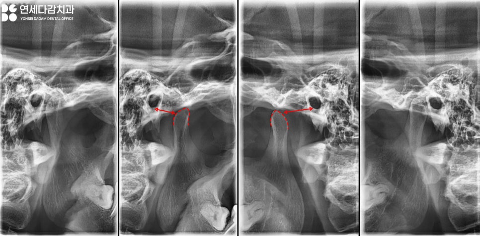 턱관절 통증 송파동 치과 에서 원인 찾고 해결 과정 살펴봅시다.(feat. 초음파 물리치료 및 보톡스 ) 관련 이미지 2