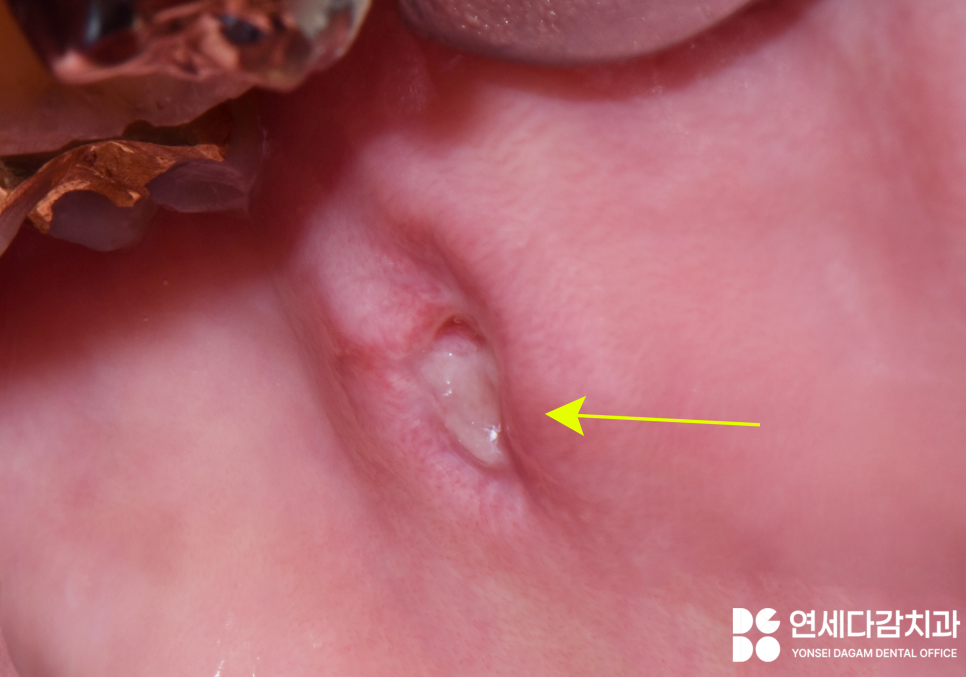 입안에 혹이 느껴진다면 외상성 섬유종 의심해 볼 수 있습니다 개롱역 치과 에서 알려드리는 원인과 치료방법 관련 이미지 5