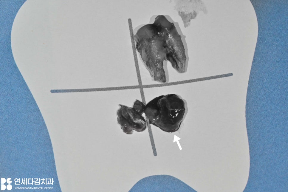 신경치료 후 크라운 떨어짐 원인으로 감염된 충치 치료 미루다 잇몸뼈 녹음 증상 개롱역 치과 발치 후 치근단 낭 적출술 관련 이미지 6
