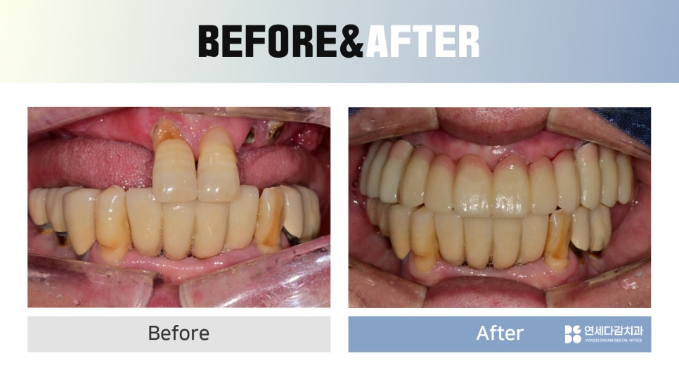 Prosthetics After Implants in Ogeum-dong: Occlusion and Facial Balance Matter Too image 9