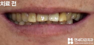 하얀 치아가 가져오는 인상의 변화 오금동 치과 교정 없이 최소삭제 라미네이트 심미치료 통해 치열 및 누렁니 개선 관련 이미지 8