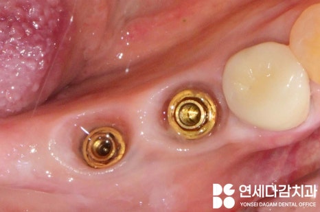 오래된 임플란트 다시 수술하지 않고 크라운 교체만 가능할까 문정동 치과 SCRP 타입으로 보철 재제작 관련 이미지 4