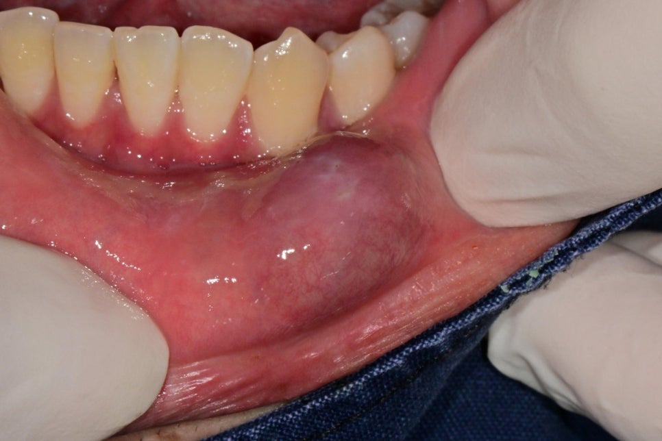 Geoyeo Station Dental Clinic, Mucous Cyst Removal&middot;What If a Lump-Like Bump Protrudes Inside Your Mouth? image 1