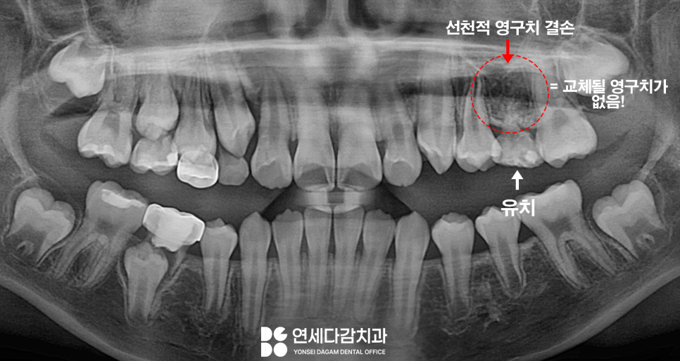 유치 빠지고 영구치 나는 시기 지났는데도 안 나온다면 문정역 치과 선천적 결손 치아 자리 지키기 위한 비발치 충치 치료 크라운 관련 이미지 2
